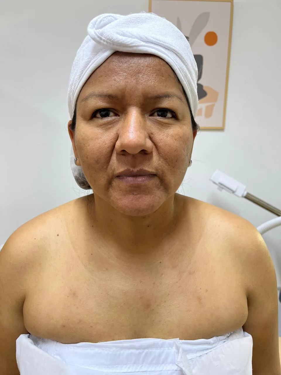 Antes del tratamiento — resultado real 1, Klass Salón & Spa