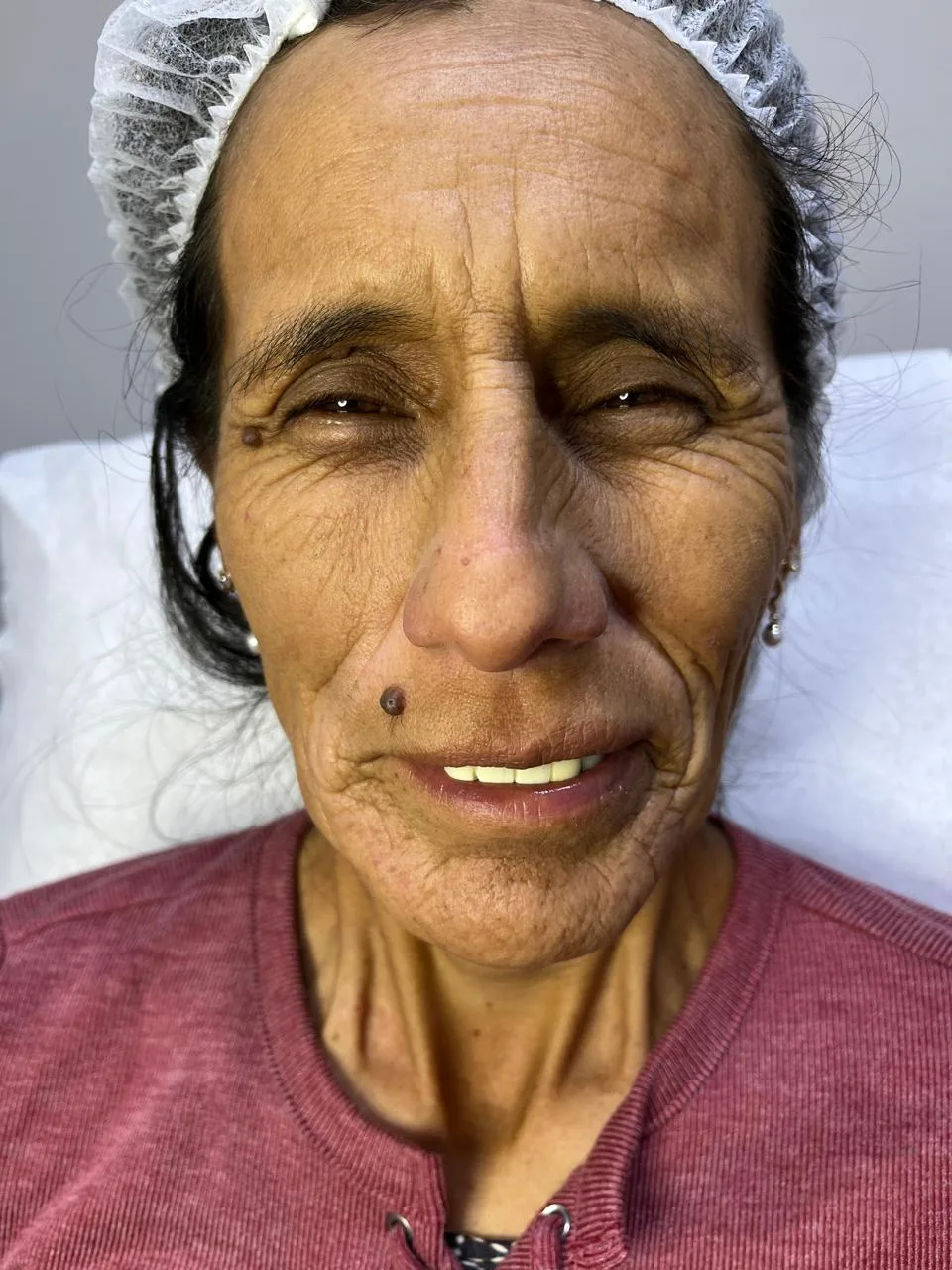 Antes del tratamiento — resultado real 10, Klass Salón & Spa