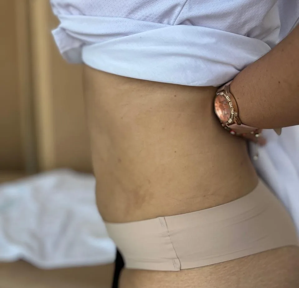 Hidrolipoclasia en Klass Salón & Spa